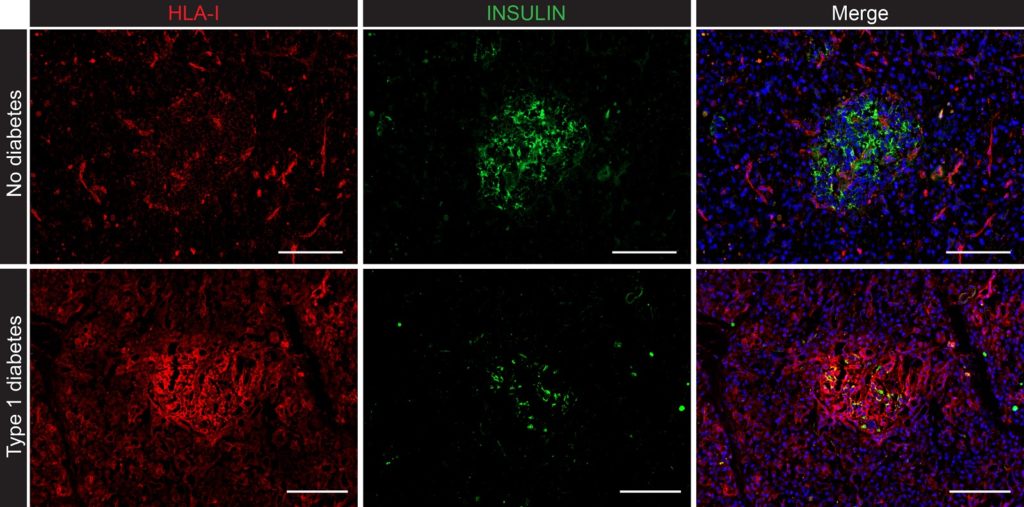 Representative immunofluorescence images from the islets of Langerhans from a non-diabetic donor showing normal HLA-I expression (top), and a type 1 diabetic donor with hyperexpression of HLA-I (bottom). Scale bars, 100 μm. Imaged collected using automated slide scanning. Image courtesy of Dr. Teresa Rodriguez-Calvo, Institute of Diabetes Research, Helmholtz Zentrum München (Germany)