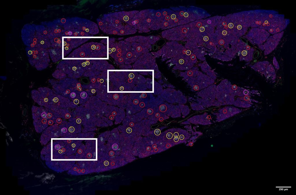 Representative immunofluorescence image of a whole pancreatic tissue section from a non-diabetic, autoantibody positive, donor stained for HLA-I, insulin, glucagon, and Hoechst. Each positive islet was assigned a colored circle based on the number of expressed interferon response markers as follows: red for the expression of one marker, yellow for two markers, purple for three markers, and blue for four markers. Scale bar, 290 μm. Image collected using automated slide scanning. Image courtesy of Dr. Teresa Rodriguez-Calvo, Institute of Diabetes Research, Helmholtz Zentrum München (Germany)