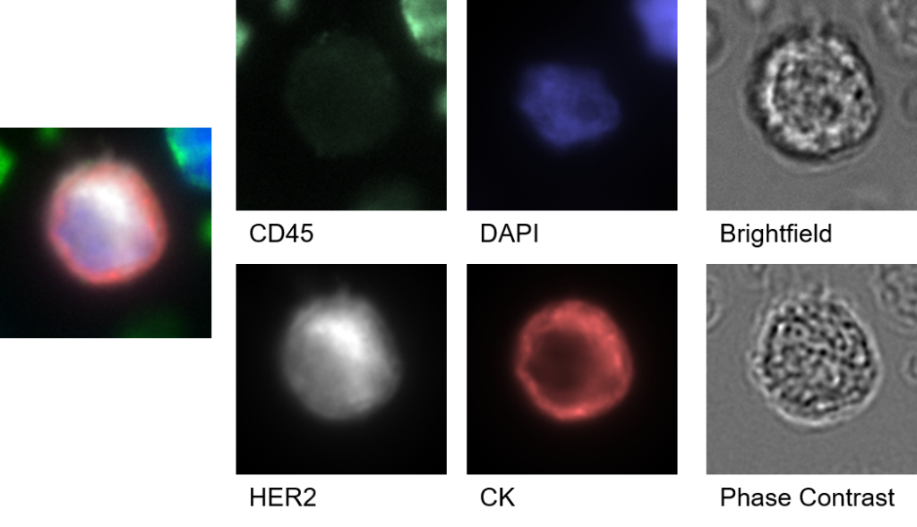 Circulating tumor cell (CTC) imaged using automated slide scanning. Courtesy: Epic Science (USA)